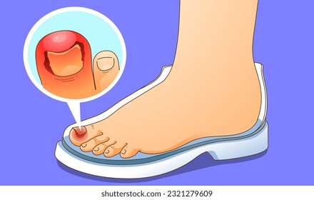 Finger with an ingrown toenail. Uncomfortable shoes. Healthcare illustration. Vector illustration.