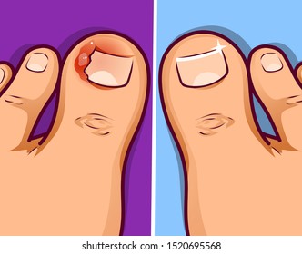 Ingrown Toenail Images, Stock Photos & Vectors | Shutterstock