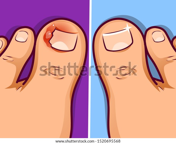 Finger Ingrown Toenail Vector Illustration Stock Vector Royalty