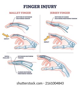 Finger injury types with common hand impact trauma anatomy outline diagram. Labeled educational scheme with mallet and jersey phalanx ligament disorder vector illustration. Sport pain explanation.