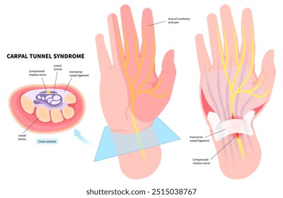 Anatomie der Hand median Nervenentzündung, die Taubheit in der Medizin verursachen