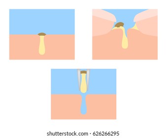 finger squeeze acne out vector