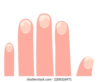 31 Discolored Nails Stock Vectors, Images & Vector Art | Shutterstock