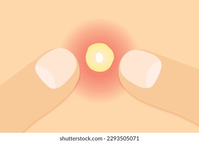 fingers squeezing a pimple- vector illustration
