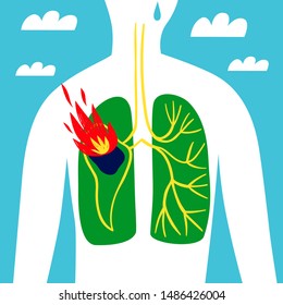 Fire In The Amazon Rainforest. Man's Body Silhouette With Lungs And Fire Inside The Shape Of South America.  Conceptual Nature And Environment Ecology Theme.