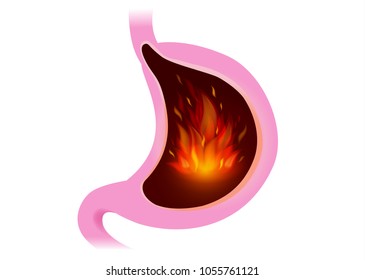 Fire Inside Stomach. Illustration About Felling Of People With Burning Sensation From Gastritis.