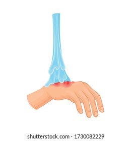 First Aid for Hand with Ambustion or Burn on the Skin Vector Illustration