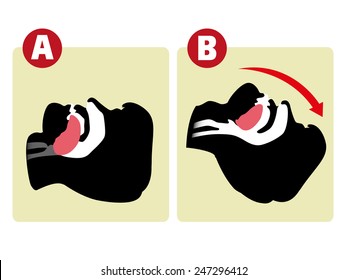 First Aid resuscitation (CPR), clearing breathing, mouth-to-mouth. For resuscitation. Ideal for training materials, catalogs and institutional