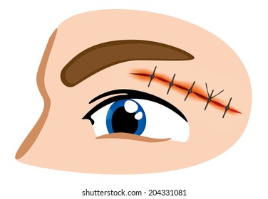 First Aid suture wound eyebrow / Illustration of a receiving first aid, injury or cut and sutured face