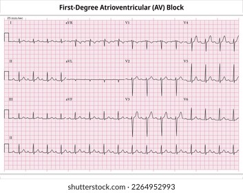 First Degree Atrioventricular Block - ECG Paper 12 Lead - Electrocardiogram - Vector Medical Illustration