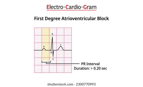 First Degree Atrioventricular Block - ECG AV Block - Study Guide Electrocardiogram - Medical Vector Illustration