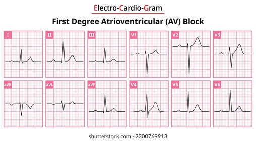 Bloque AV de primer grado (auriculoventricular) - Las diferencias en la forma de onda ECG para cada uno de los 12 plomos - Vectores e ilustraciones para fines médicos