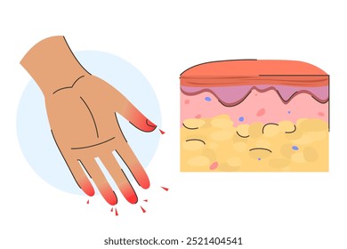 First frostbite stage infographic vector isolated. Damaged fingers. Signs of hypothermia. Concept of health care, symptoms of frostbite. Frostnip.