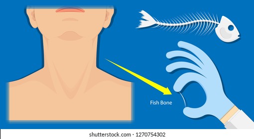 Fish Bone Stuck in Throat