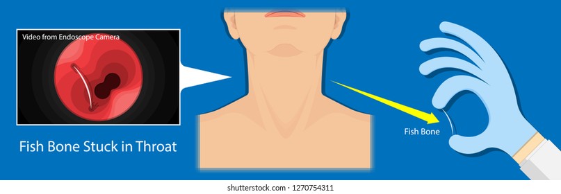 Fish Bone Stuck in Throat