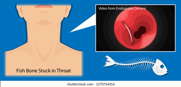 Fish Bone Stuck in Throat