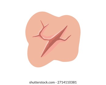 Fissure Deep Crack in Skin