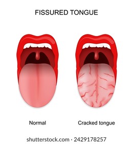 Reißende Zunge. Gesunde und rissige Zunge. Anomalien der Mundhöhle. Vektorgrafik