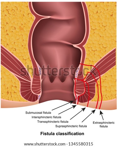fistula classifications medical vector illustration on white background with description