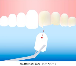 fitting veneers white teeth, ugly teeth
