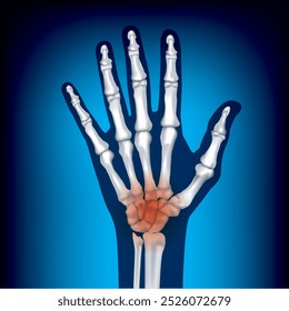 Huesos de cinco dedos de un hombre sobre un fondo azul. Huesos de una mano humana sobre un fondo azul. Inflamación articular. Afiche médico. Ilustración vectorial