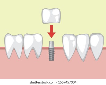 Five healthy molars in a row. A vector color illustration of white teeth for dental clinic. The concept of modern dentistry and new technologies of medicine