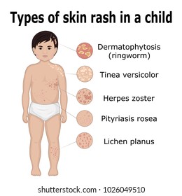 Five types of skin rashes on the body of a small child