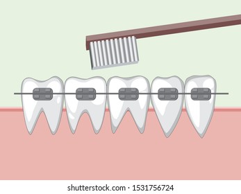 Five white teeth in the gum with metal braces. Toothbrush brushes teeth to maintain oral cleanliness.