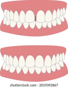 Fix The Gap Between Front Teeth