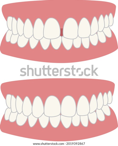 fix the gap between front\
teeth