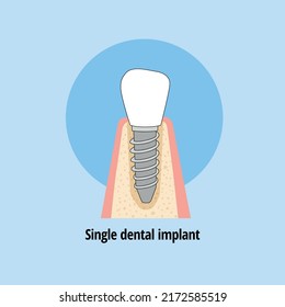 Fix Tooth Loss With Single Dental Implant And Crown