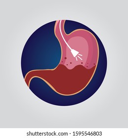 Flat cartoon endoscope in stomach through esophagus.