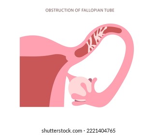 Gráfica plana de tubo falópico obstruida. Bloqueo del tubo de útero esquema de alta ampliación