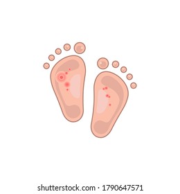 flat child foot with redness. concept of first walk barefoot kid, two small leg, new family member, news for mom, dad. sticker for medical apps, sites. drawing sign isolated