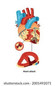 Flat color heart attack anatomy poster vector illustration