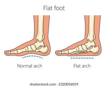 Flat feet bones schematic vector illustration. Medical science educational illustration