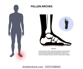 Flat feet medical poster. Abnormal feet arch condition, supination. Body balance problem. Flatfoot concept. Ankle pathology diagnostic, treatment in podiatry clinic medical flat vector illustration