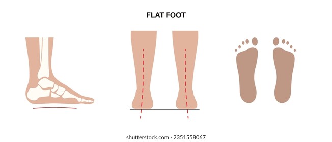 Flat feet medical poster. Abnormal feet arch condition, supination. Body balance problem. Flatfoot concept. Ankle pathology diagnostic, treatment in podiatry clinic medical flat vector illustration