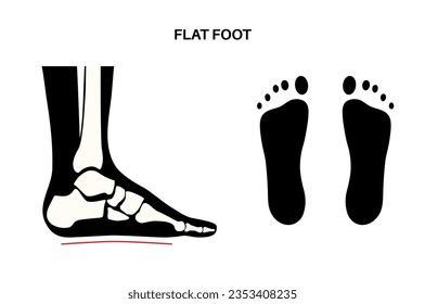 Flat feet medical poster. Abnormal feet arch condition, supination. Body balance problem. Flatfoot concept. Ankle pathology diagnostic, treatment in podiatry clinic medical flat vector illustration