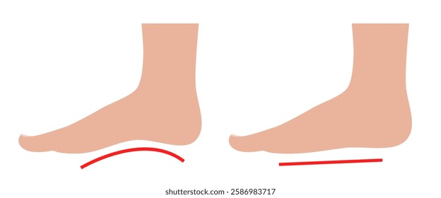 Flat feet. Normal foot and flat foot. Vector illustration.