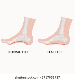 Flat feet vector illustration showing fallen arches, foot pain, swelling and fatigue, with related conditions like plantar fasciitis, overpronation, arthritis and tendonitis.icon