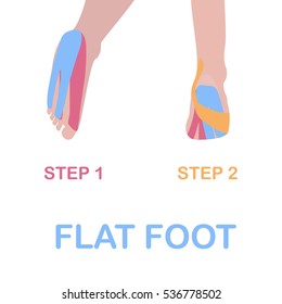 Flat foot. Correct kinesiology taping. Vector illustration.