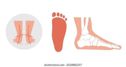 Flat foot and footprint. Orthopedist diagram infographic