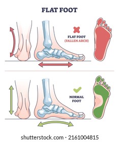 Flat foot pathology with fallen and normal arch comparison outline diagram. Labeled educational scheme with ankle and feet bone stretching position vector illustration. Medical human skeleton disease.