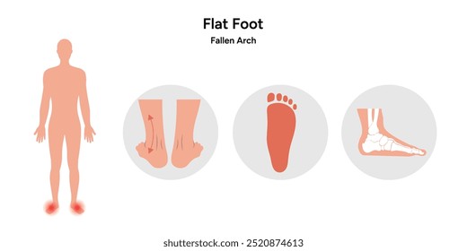 Flat footprint. Fallen arch. Orthopedist diagram infographic