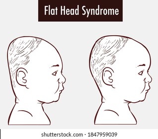 Flat Head Syndrome  Brain  vector illustration