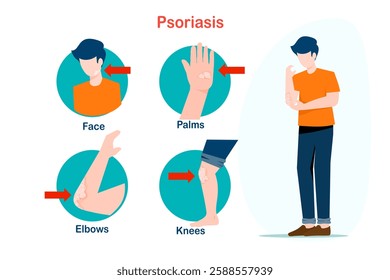 Flat illustration of health care concept. Body parts that are affected by psoriasis,such as elbows,knees,face and palms.