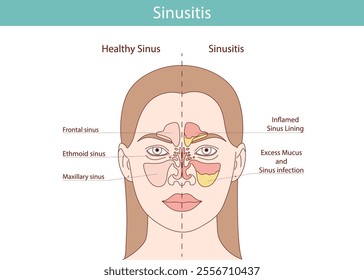 Flat image of sinusitis and sinusitis. Infections, inflammations, nasal diseases.