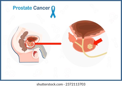Flat medical illustration concept of prostate cancer. Male reproductive system and prostate cancer.