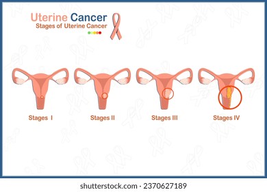 Ilustración vectorial médica plana de 4 etapas de cáncer uterino sobre fondo blanco.